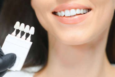 cómo se hace un blanqueamiento dental