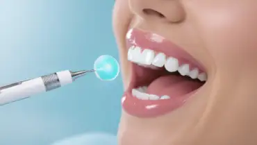 blanqueamiento dental profesional vs casero